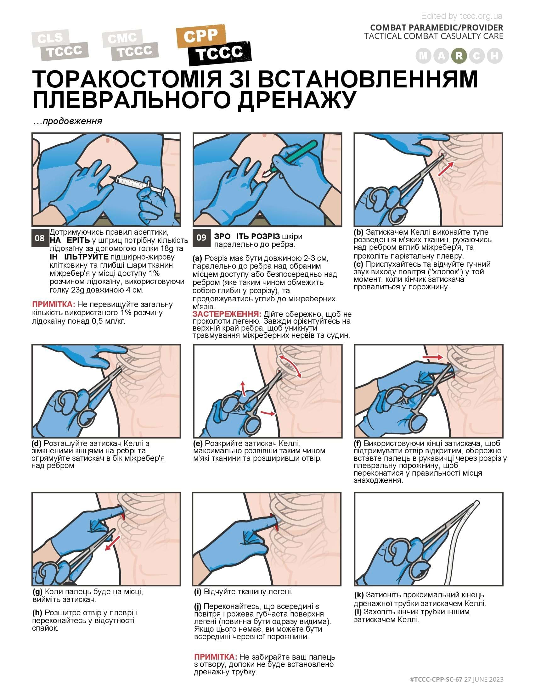 Торакостомія зі встановленням плеврального дренажу, cpp, сторінка 2