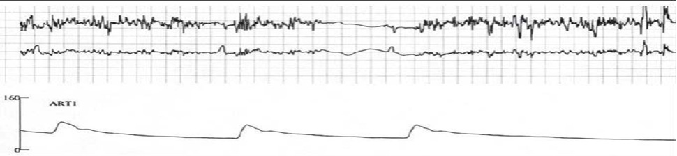 An example of EMI that causes pacemaker inhibition