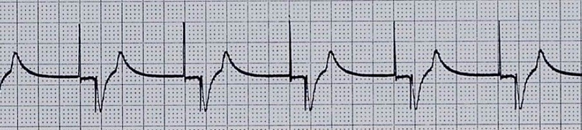 An example of loss of atrial capture