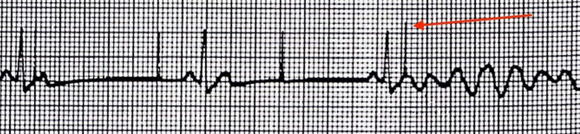 An example of R-on-T from a pacemaker