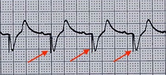Ventricular pacing with capture