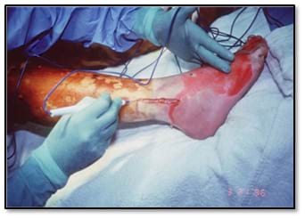 Escharotomy of the leg, using electrocautery