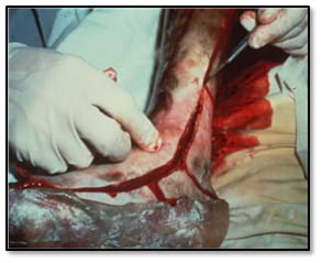Escharotomy of the leg and foot, using a scalpel
