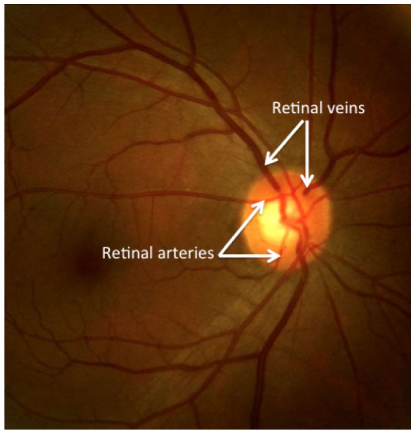 Typical appearance of a healthy retina
