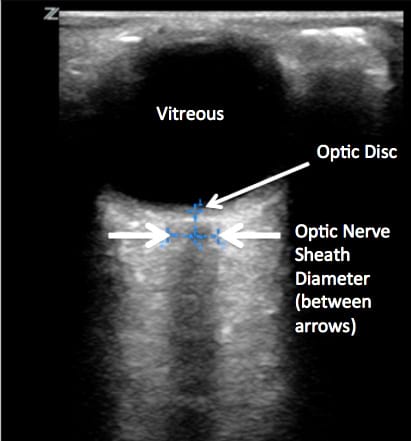 An ultrasonographic view of a normal eye and optic nerve sheath.