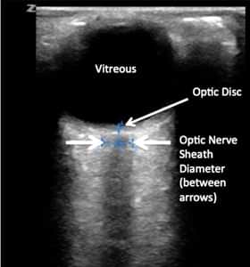 An ultrasonographic view of a normal eye and optic nerve sheath