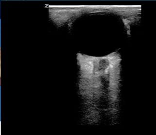 Ultrasound image of the right optic nerve sheath of a 61-year-old man with a traumatic subdural hematoma